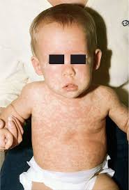 Most viral rashes start with a fever. Rashes In Infants And Children Pediatrics Tintinalli S Emergency Medicine Just The Facts 3ed