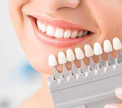 Welcome tothe bowie dental group. Dental Veneers Bowie Md Gateway Dental Dr William Swann Dds Porcelain Veneers Near Me Laminates