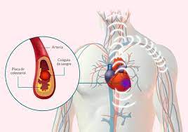 Sob estas condições qualquer um dos seguintes critérios se. Para Ti Uma Enfermeira Enfarte Agudo Do Miocardio Oqueseama