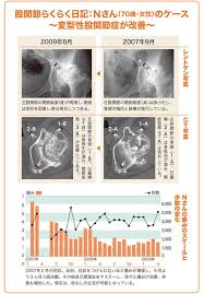 変形性股関節症を自分で治す 手術も回避できる 医師推奨 股関節らくらく日記 ケンカツ health beauty health movie posters