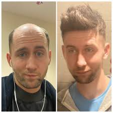 Ginkgo biloba is an herb that can help strengthen the hair shaft, which discourages hair thinning. The Introduce Of A Solution For Thin Hair Male