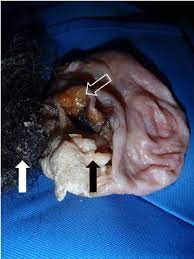 Feb 11, 2020 · @alwaysclau: The Contents Of The Removed Cyst Revealed Rudimentary Calcific Teeth Download Scientific Diagram