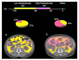 Cancers Free Full Text Visceral Adipose Tissue Radiodensity Is Linked To Prognosis In Hepatocellular Carcinoma Patients Treated With Selective Internal Radiation Therapy Html