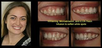 Eliminate White and Brown Spots