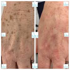 Image result for liver spots on legs