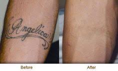 If playback doesn't begin shortly, try restarting your device. 16 Tatto Removal Ideas Tattoos Tattoo Removal Laser Tattoo