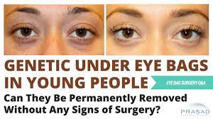 Eye Bags Are Genetic And Can Appear In Teenagers - Options For Treatment -  Youtube