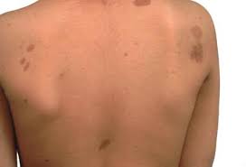 Type 1 Neurofibromatosis - Symptoms, Diagnosis And Treatment | Bmj Best  Practice Us