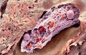 Thrombose Und Krebs Prophylaxe Und Therapie