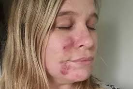 Covid left me looking like a monster, I even hid from my daughter'