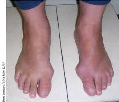 Morton's neuroma of the foot is a common problem that results in swelling and inflammation of the nerves. Can Orthoses Have An Impact For Bunions Hammertoes And Morton S Neuromas Podiatry Today