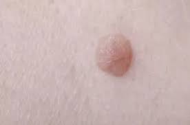 It can cause inflammation, pain and tiny bumps in the area where the hair was removed. What Is The Difference Between An Ingrown Hair And A Wart How Do I Tell Quora