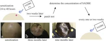Alopecia universalis (au) is a condition characterized by the complete loss of hair on the scalp and body. Effect Of Topical Immunotherapy With Squaric Acid Dibutylester For Alopecia Areata In Japanese Patients Sciencedirect