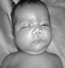 Patient shows lack of facial expression, lip cornered downwards and...