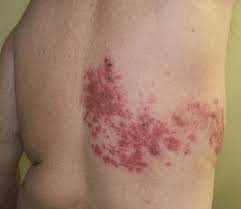 Terminology and types of common childhood rashes. Herpes Zoster Core Em