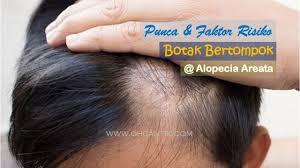 Keguguran rambut ini biasanya jelas kelihatan apabila seseorang menyikat kalangan lelaki, mereka yang mengalami masalah rambut sekiranya tidak dirawat dalam tempoh 10 tahun sekalipun keadaan rambut mereka. Punca Botak Bertompok Cara Atasinya Ohcantik Com