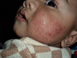 Hello, my son is very allergic to rapeseed/canola, wheat, almonds, and  corn. Does anyone have a moisturizer they could recommend? He has very dry  skin due to eczema and really needs relief!