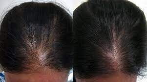 These fats can be absorbed either by eating spirulina , or using it. Spirulina Powder Growth Before And After Thick And Silky I Ve Solved The Problem Of Hair Loss Just In 1 Week I Ve Completely Repaired All Lost Hair In 2 Months Spirulina