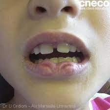 Vous pressentez déjà que demain vous allez avoir un petit ulcère dans la bouche. Les Morsures Des Joues Et De La Langue Conseil Dentaire Dr Hauteville