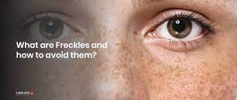 Freckle On Skin: Treatments & How To Prevent Them | Clearskin, Pune