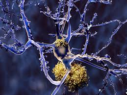 Aducanumab is currently not approved for clinical use in alzheimer's disease and cannot currently be prescribed by your doctor. Aducanumab Approved For Treatment Of Alzheimer S Alz Org