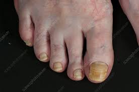 Image result for Yellow nail syndrome feet