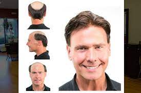 Considering salon from these websites will be a good option for you because their first priority is the condition of your hairs. Cape Coral Hair Salon Hair Replacement Hair Regrowth Services