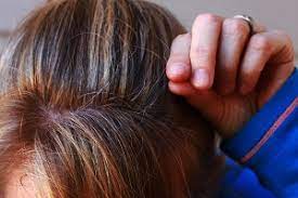 Haarausfall In Den Wechseljahren Symptome Verlauf Behandlung