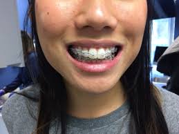 Pin By Your Smile Orthodontics On Huntington Woods Ortho Office Nose Ring Septum Ring Ortho Office