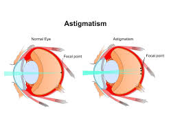 The specific purpose of this corporation is to provide prescription eyeglasses and to help arrange vision and eye health care appointments with community eye care professionals for. Astigmatism Treatment Optometrist In Sacramento Arena Eye Care Optometry