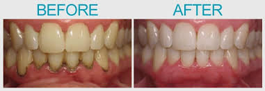 Image result for Gingivitis