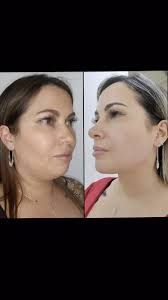 #perfiloplastía #claseiiesqueletal