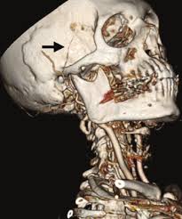 Image result for Jaw Claudication