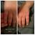 When To Drain A Smashed Finger