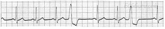 On an electrocardiogram, or ecg, which measures the electrical activity of the heart via electrodes that are placed on the skin, the atrial depolarization and its. Ecg Basics Normal Sinus Rhythm With Premature Ventricular Contractions Ecg Guru Instructor Resources
