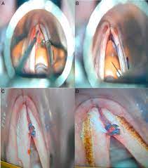 Wendler glottoplasty does not worsen voice quality based on acoustic measures. Wendler Glottoplasty And Voice Therapy In Male To Female Transsexuals Results In Pre And Post Surgery Assessment Sciencedirect