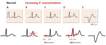 Action Potential - Wikipedia