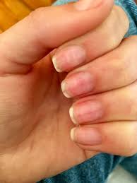The only problem i still have is lifting. Remedies For Nail Pain After Removing Acrylic Nails Thriftyfun