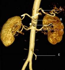 Can You Identify The Structures Labelled A To E In This Abdominal Magnetic Resonance Angiogram Answers At Http Abdominal Aorta Abdominal Magnetic Resonance