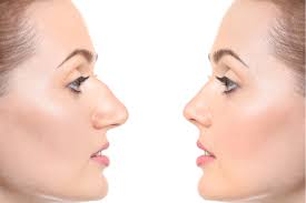 Information and translations of nose job in the most comprehensive dictionary definitions resource on the web. Rhinoplasty Or Nose Surgery In Iran