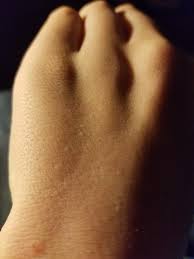 They wouldn't come off and he hadn't. I Have These Weird Bumps On My Hand I Dont Feel Any Pain Or Things Like That They Just Stick Out Medical
