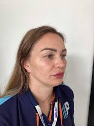 Cheekbone fillers from £155