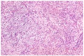 The majority of malignant mesotheliomas originate in the pleura. Diagnostics Free Full Text Ewsr1 The Most Common Rearranged Gene In Soft Tissue Lesions Which Also Occurs In Different Bone Lesions An Updated Review Html