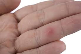 Splinter Removal 101 When To Diy And When To Go For Urgent Care