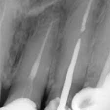 Olivia hart of richmond, va to learn about the similarities and differences of dental crowns and bridges. Iopa Of Upper Left Lateral Incisor With Richmond Crown Placement Download Scientific Diagram