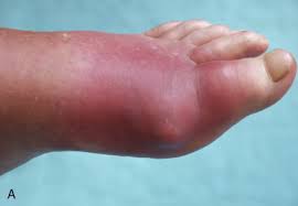 Image result for Septic Joint