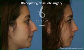 Please look carefully at the postoperative images. Rhinoplasty Before And After Pictures Botonics
