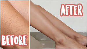 Ingrown hair comes out of skin eventually. How To Get Rid Of Strawberry Legs Ingrown Hair My Shaving Routine Youtube