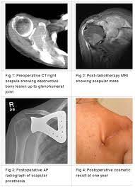Mar 04, 2021 · shoulder blade pain can result from breast cancer treatment or, in rare cases, can be a sign that cancer has spread to other areas of your body. Case Study Solitary Plasmacytoma Of The Scapula Oncology Nurse Advisor