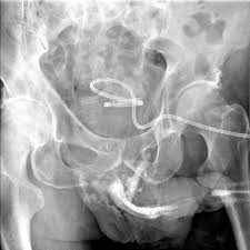 Image result for Retrograde Urethrogram